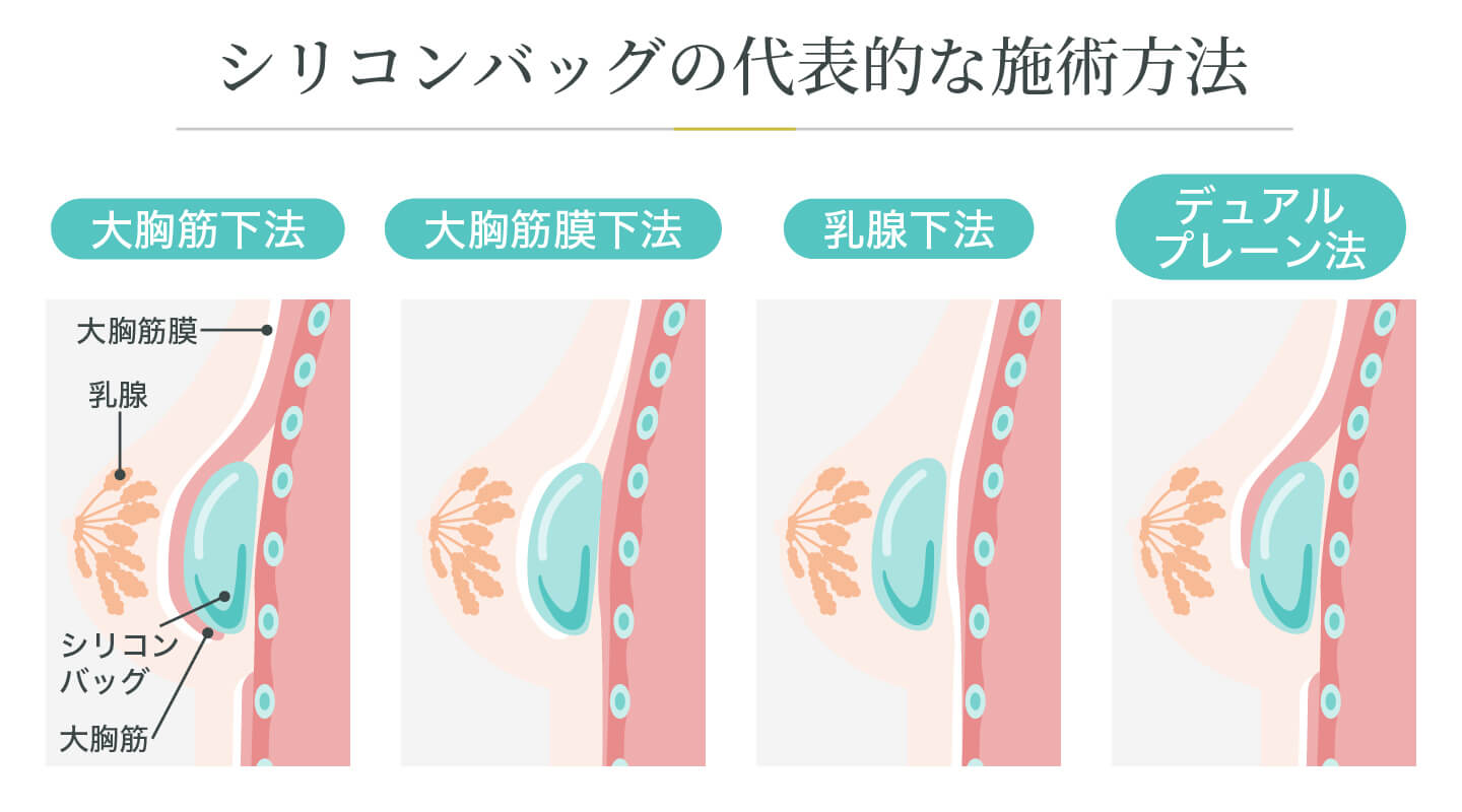 シリコンバッグ豊胸の施術方法